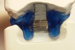 offener Biss-Ativator mit Zungengitter 2